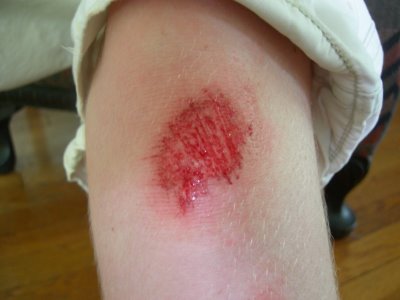 How to treat different types of cuts, grazes, and gashes - We Can