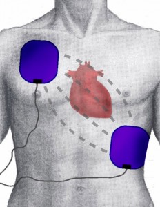 Defibrillation_Electrode_Position
