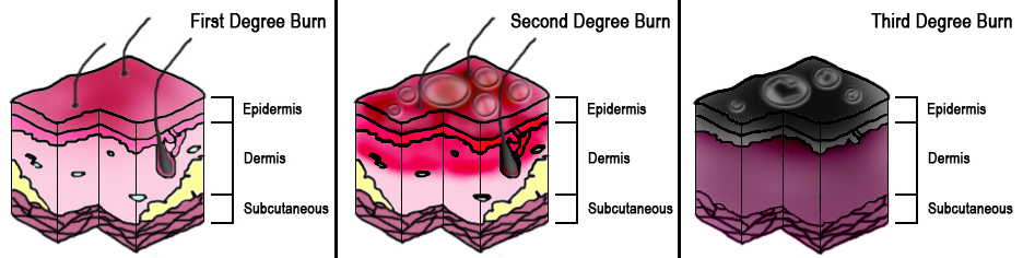 Classification of Burn Injury Depth | First Aid for Free