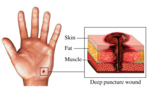 Puncture wound first aid