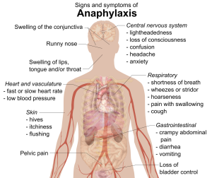 Anaphylaxis signs and symptoms