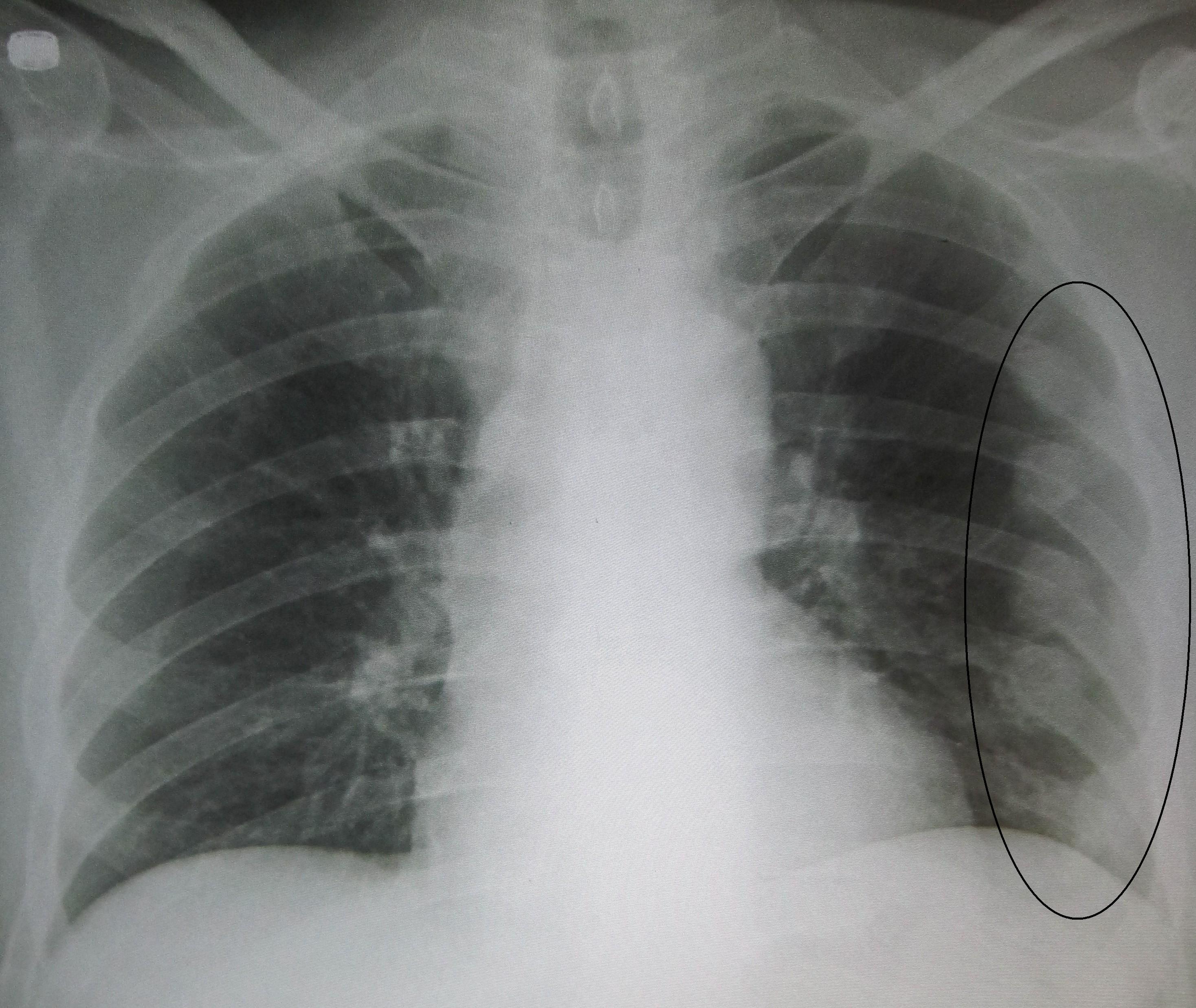 Broken Rib Punctured Lung