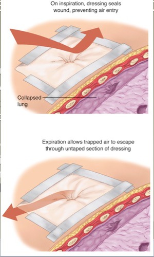 First Aid in Chest Injuries