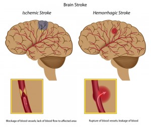 Types of Stroke