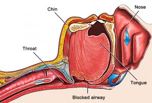 Voies respiratoires bloquées