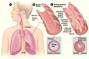 Asthma first aid