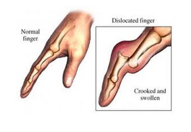 First aid for Dislocations - First Aid for Free