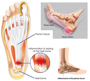 First aid for Plantar Fasciitis First Aid for Free