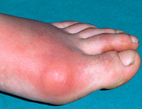 First aid for gout