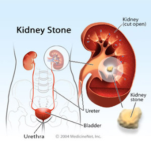 First aid for kidney stones