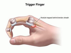 First aid for Trigger Finger