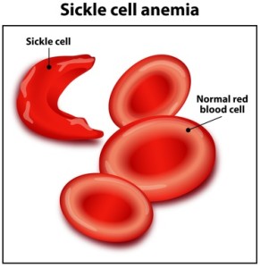 Sickle cell crisis first aid