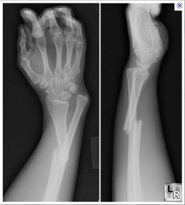 Complications of fractures