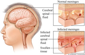 First aid for meningitis