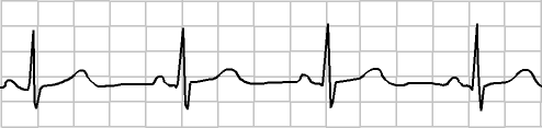 A guide to heart rhythms for first aiders - First Aid for Free