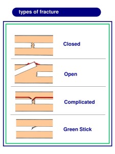 Types of Fracture first aid