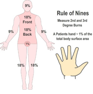 The Rule of Nines for Burns and Scalds