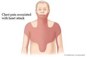 Heart attack left arm pain