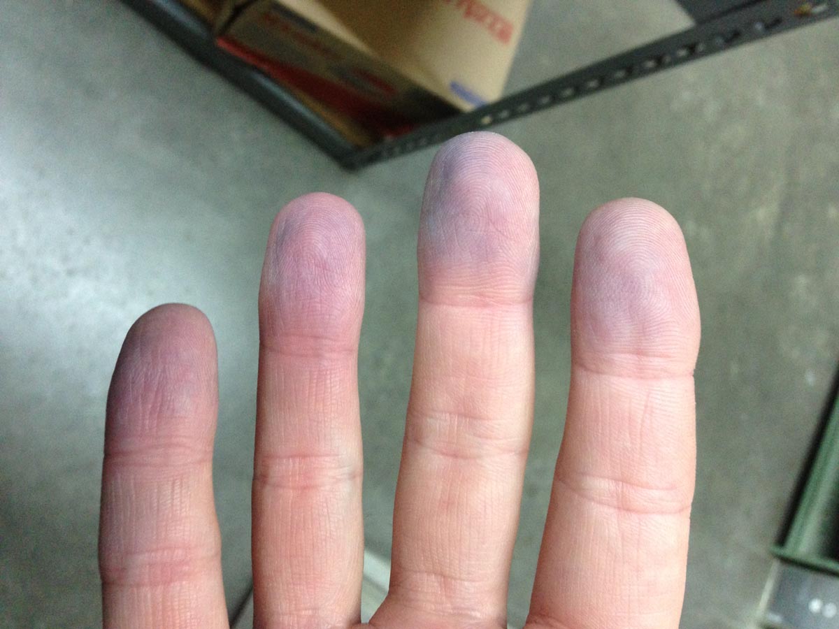 Peripheral Cyanosis showing blue finger tips