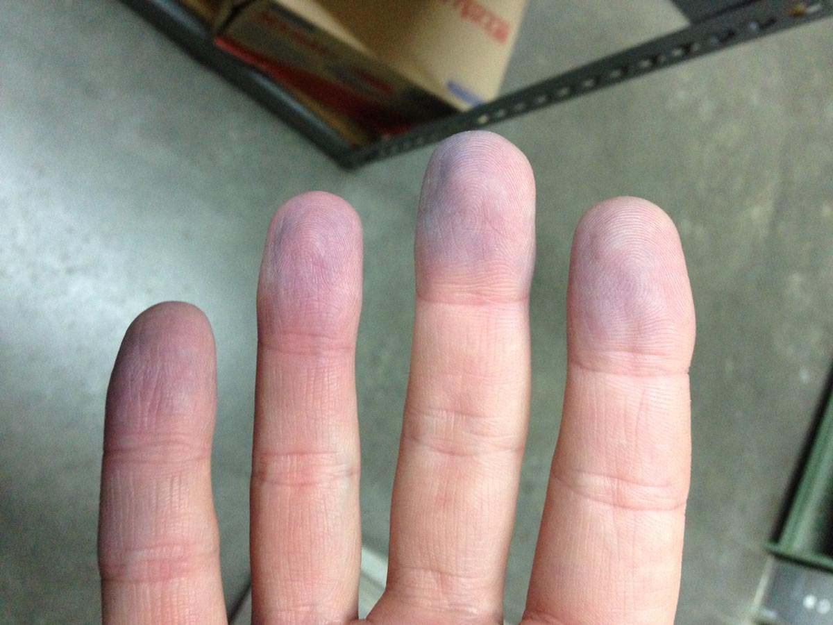 Blue to Slate Gray Discoloration of the Proximal Fingernails | MDedge  Dermatology