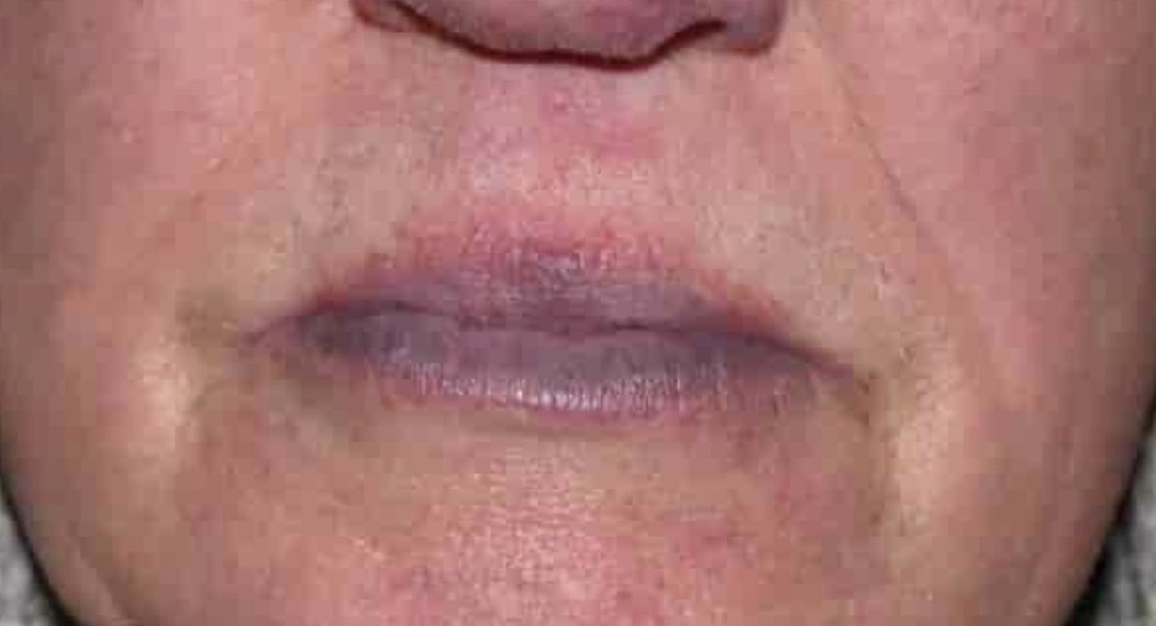 Circumoral (Perioral) Cyanosis showing blue tint to the lips