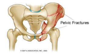pelvic-fractures-first-aid