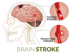 stroke-first-aid