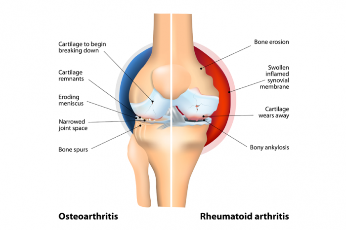 osteoarthritis rheumatoid arthritis kezelése