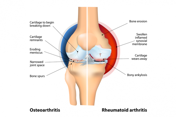 osteoarthritis-vs-rheumatoid-arthritis