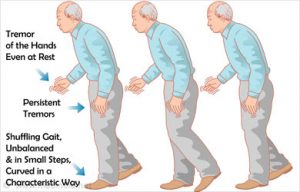 symptoms-of-parkinsons-disease