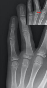 Broken Finger X Ray 