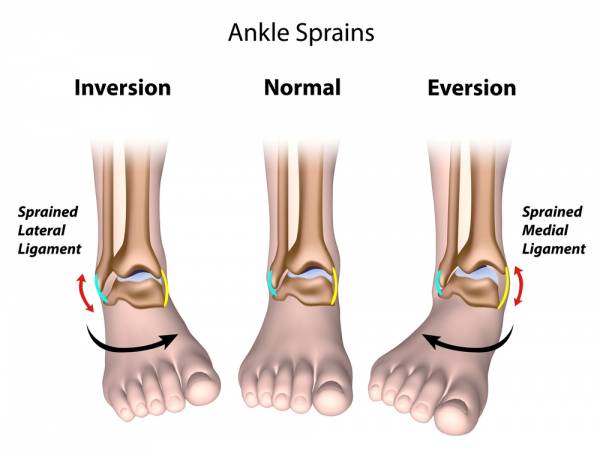 Sprain First Aid - First Aid for Free