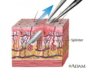 How to remove a splinter - First Aid for Free