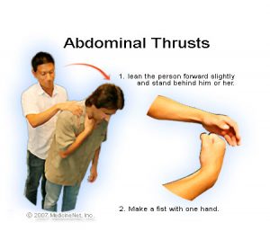 What is choking?