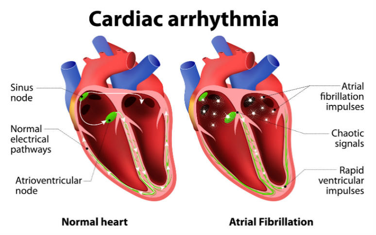 literature review of cardiac arrhythmia