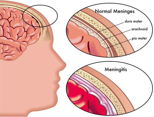 Viral meningitis