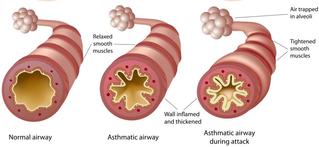 What Are Asthma Symptoms? | Aafa.org