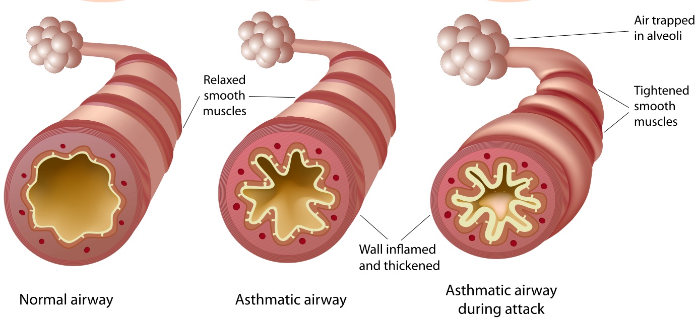 essay about asthma