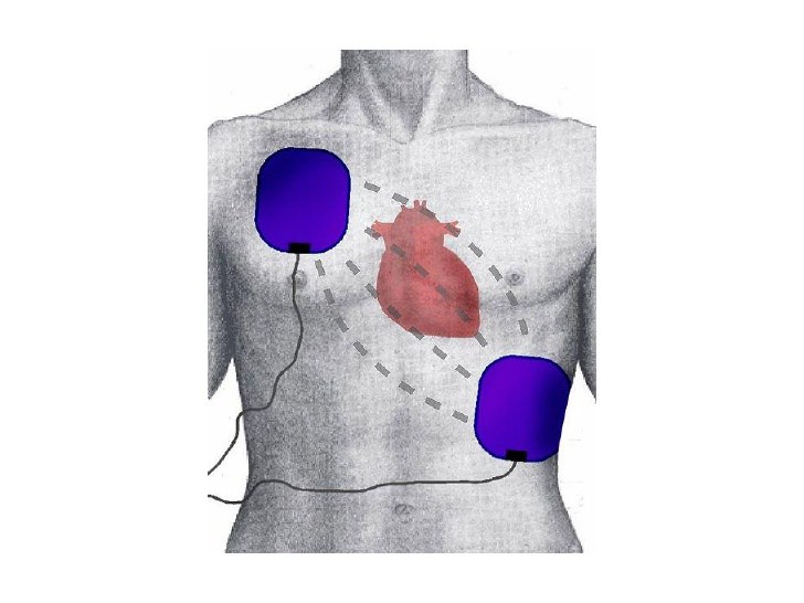 Correct AED Pad Placement - First Aid for Free