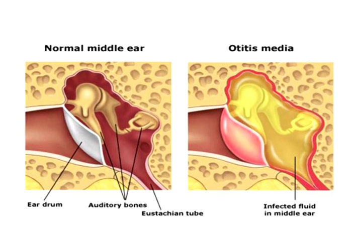 Middle Ear Infections in Children | First Aid for Free