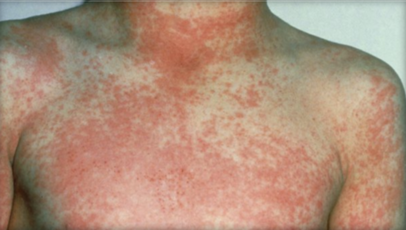 Scarlet Fever (Scarlatina): Causes, Symptoms, and Treatment