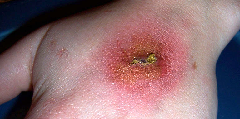 Infected wound on hand