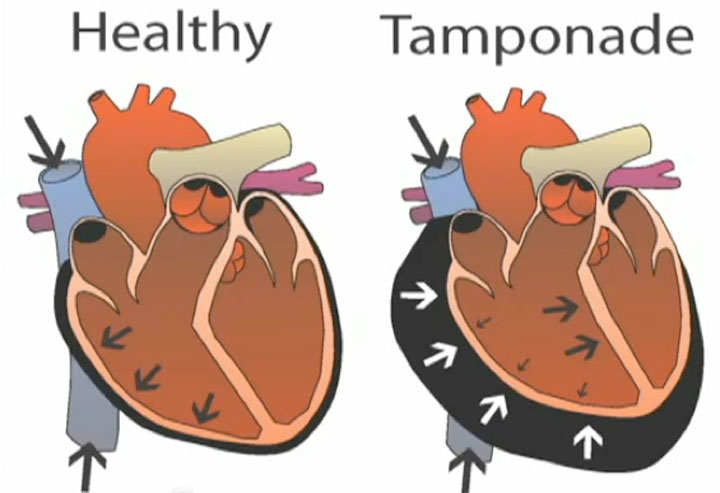 cardiac tamponade symptoms