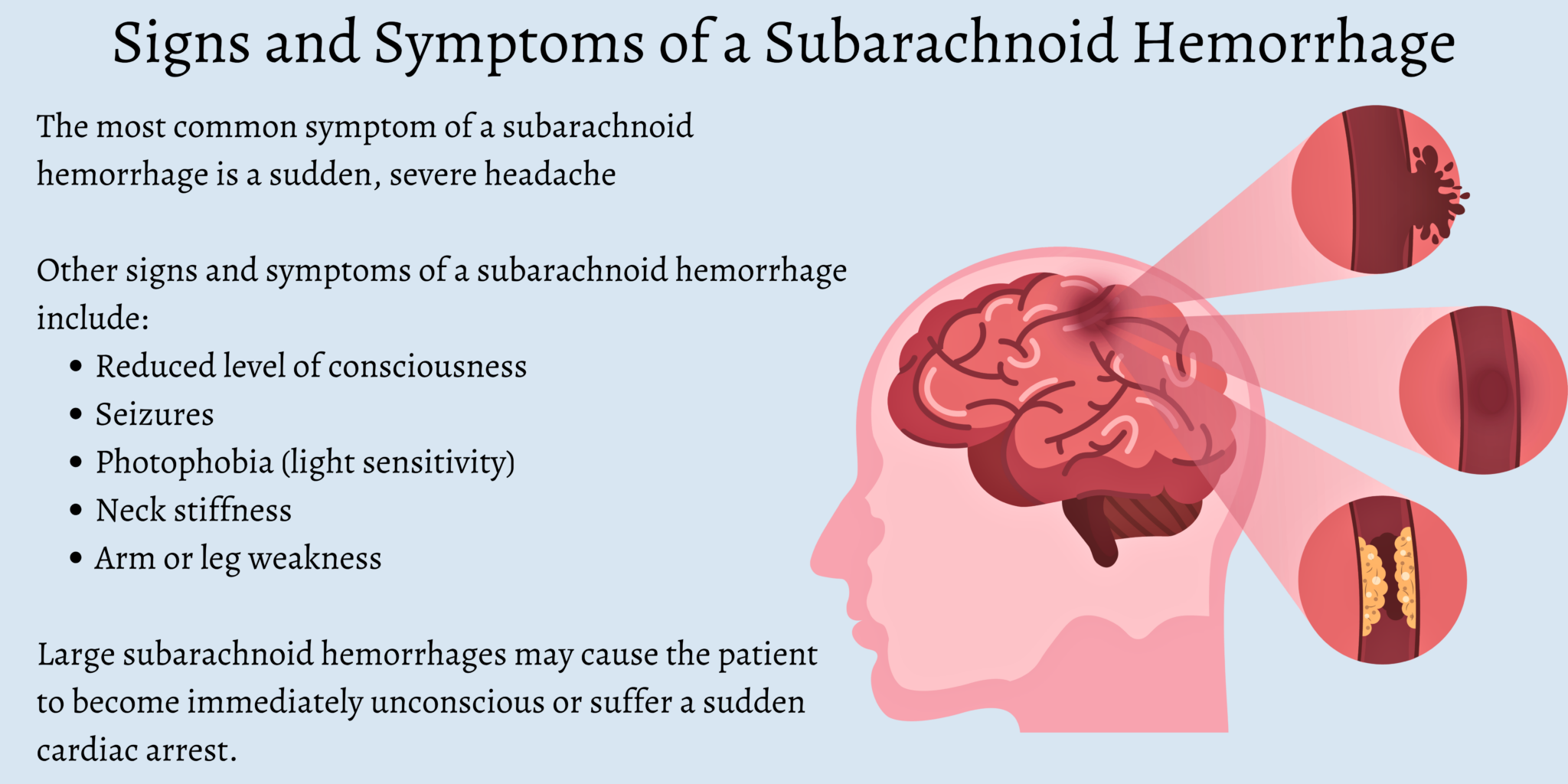 What is a Subarachnoid Hemorrhage (SAH)?