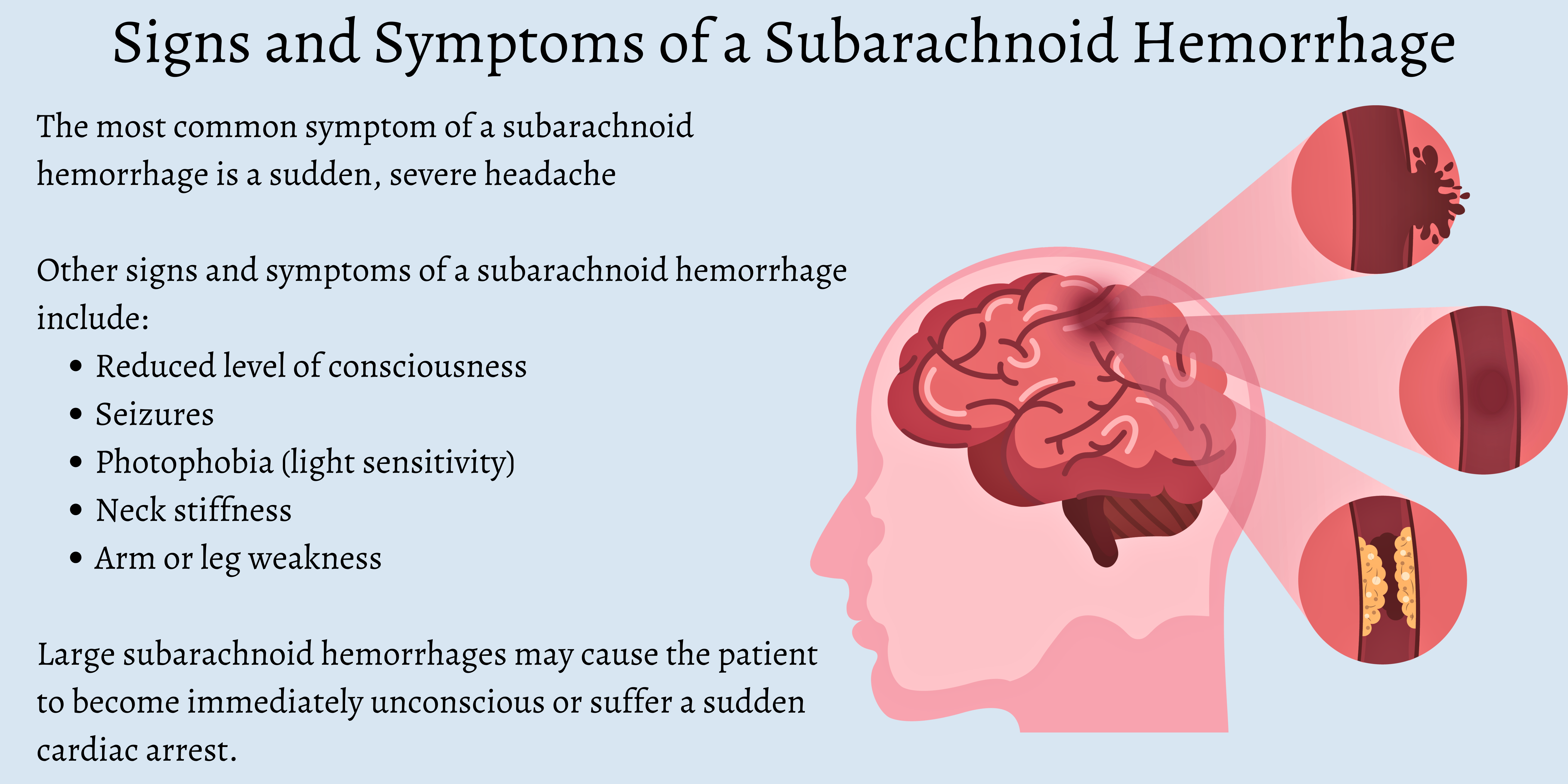 What is a Subarachnoid Hemorrhage (SAH)?