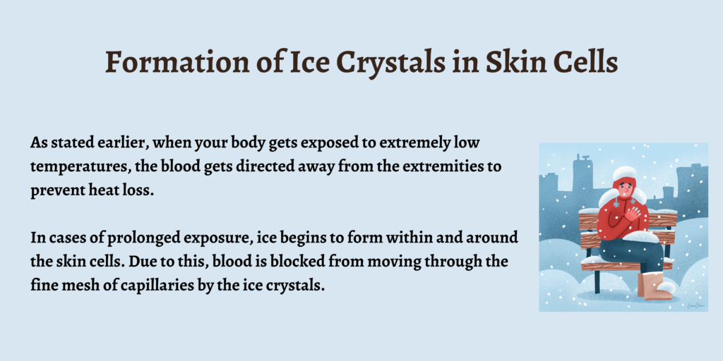 Formation of Ice Crystals in Skin Cells